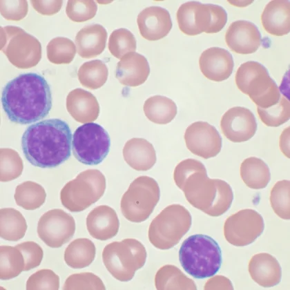 Chronická lymfocytová leukémia